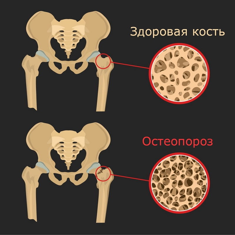признаки остеопороза костей
