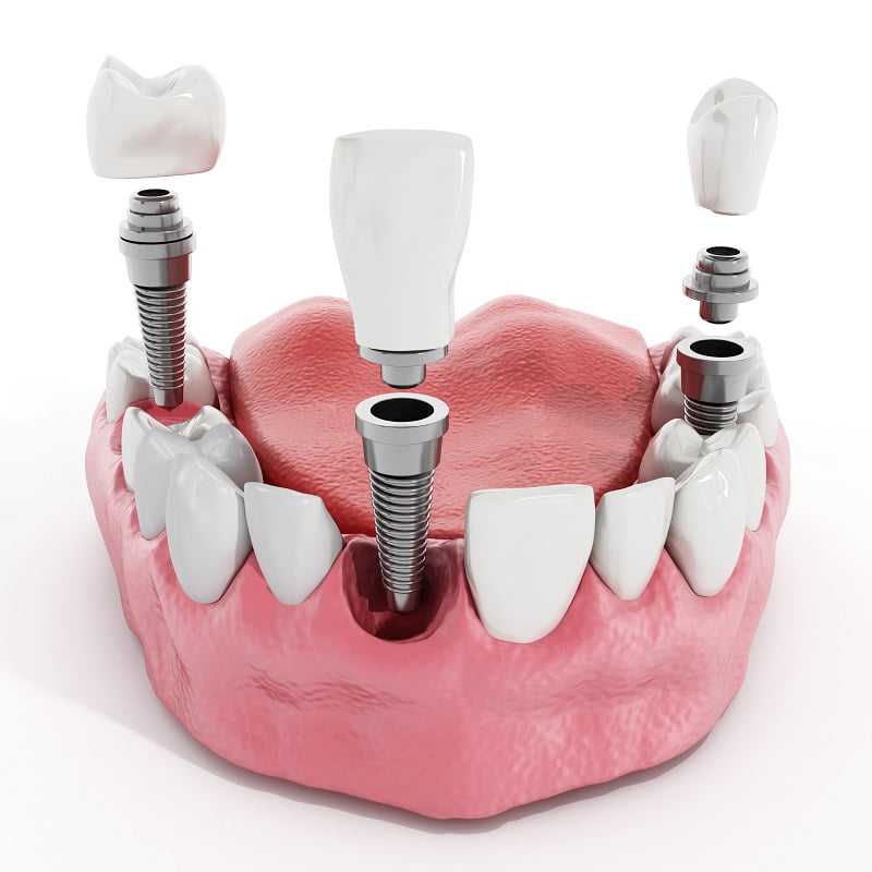 отзывы об установке зубных имплантов